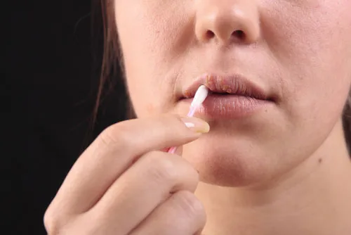 Virus herpes simplex (HSV) gây bệnh giộp môi