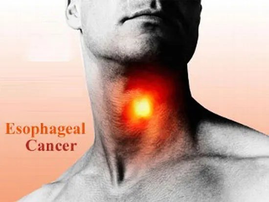EAC thường bắt nguồn từ một căn bệnh với tên gọi là Barret thực quản, hình thành do mắc chứng trào ngược axít mãn tính