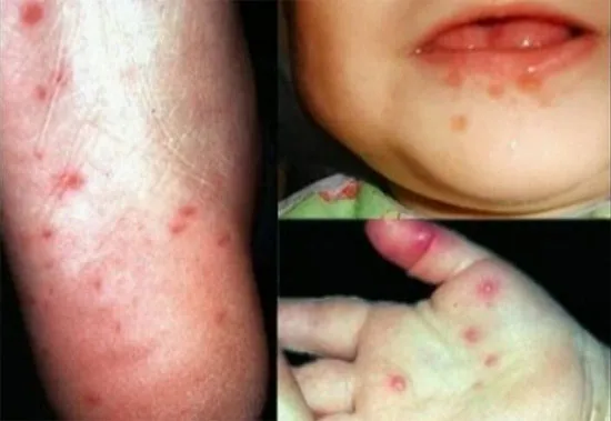 Nhiễm trùng gây phát ban trên bàn tay và bàn chân cũng như loét miệng.