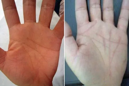 Lòng bàn tay của một người trước khi phẫu thuật (trái) và sau khi phẫu thuật tái tạo các đường chỉ tay "thay đổi số phận" mới (phải).