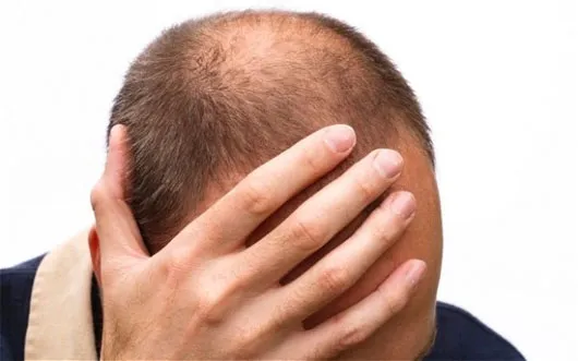 Đàn ông sợ hói đầu hơn bị "bất lực"