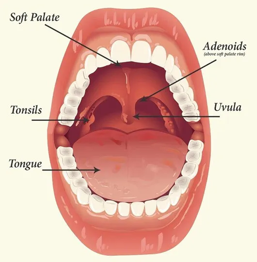 Sỏi amidan
