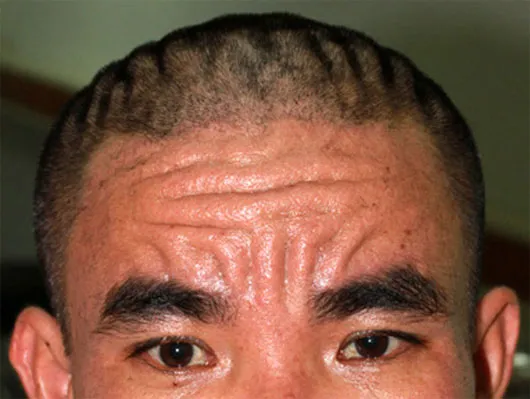 Gương mặt bệnh nhân Q. có nhiều nếp gấp lồi lõm