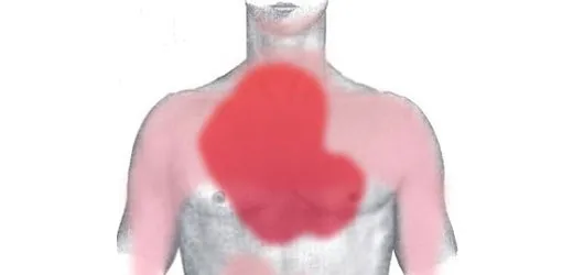 Nạn nhân bị đau tim