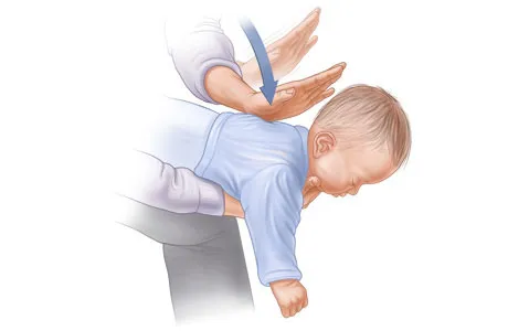 Làm thế nào để cứu người đang bị tắc thở vì dị vật trong cổ họng