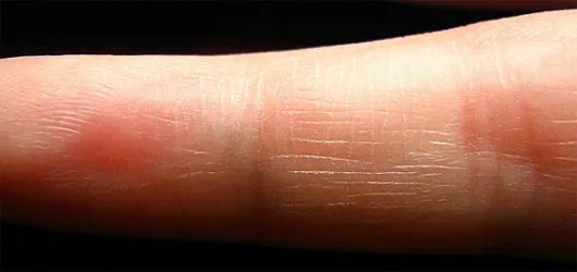 Sơ cứu vết bỏng