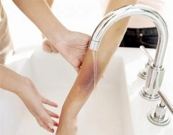 Xử lý vết thương bị bỏng