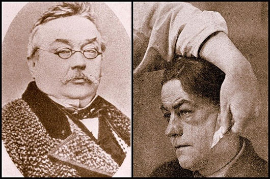 Ferdinand Ritter von Hebra - một trong những người tiên phong trong phương pháp "lột da mặt"