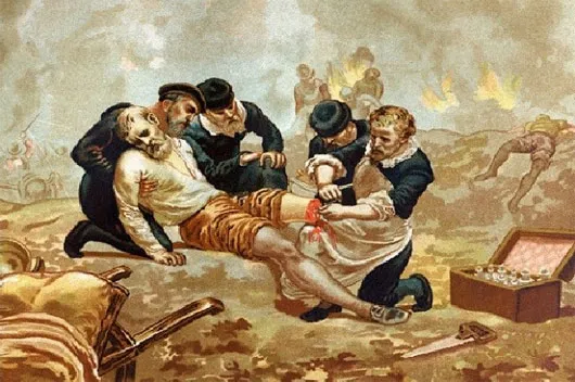 Bức ảnh diễn tả quá trình phẫu thuật của bác sĩ Ambroise Paré thế kỷ XVI