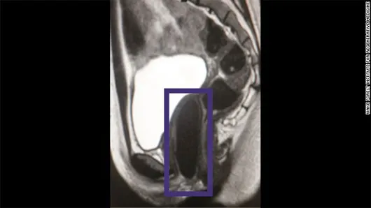 Ảnh chụp cộng hưởng từ cho thấy âm đạo nhân tạo bên trong cơ thể bệnh nhân