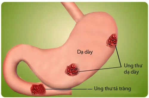 Viêm loét dạ dày là bệnh phổ biến hàng đầu trong các bệnh đường tiêu hóa. Bệnh có thể gây ra biến chứng là ung thư dạ dày