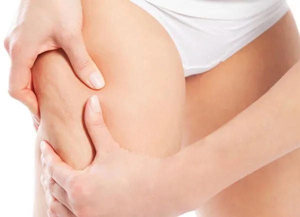 Lý do khiến da sần sùi như vỏ cam
