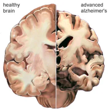 Não bình thường (bên trái) và não bị Alzheimer