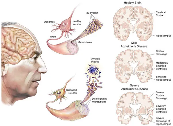 Vì sao phụ nữ mắc bệnh Alzheimer nhiều hơn nam giới?