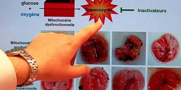 Các gốc tự do superoxide là nguyên nhân thúc đẩy quá trình di căn của khối u