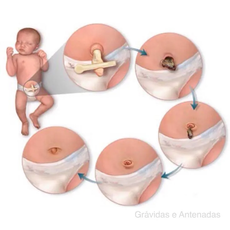 Quy trình rụng rốn của trẻ sơ sinh