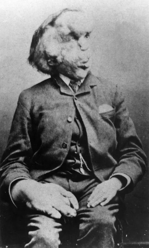 "Người voi" Joseph Merrick
