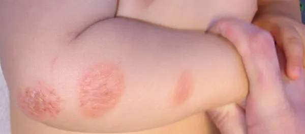 Chàm sữa trẻ em