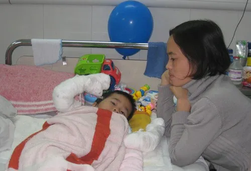 Bé Nam bị bỏng nước sôi trên diện rộng.