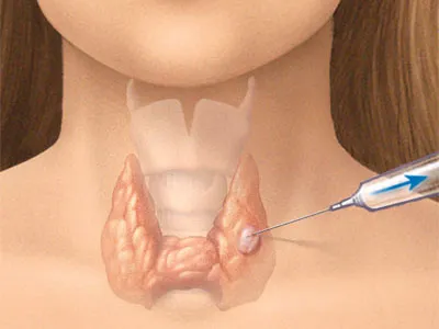 Ung thư tuyến giáp nếu phát hiện sớm có thể điều trị khỏi