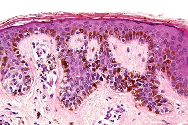 Các tế bào nevus bị tổn thương tạo thành nốt ruồi