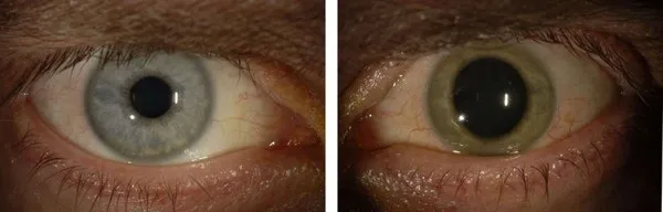 Màu mắt của Croizier trước (trái) và sau (phải) khi nhiễm Ebola