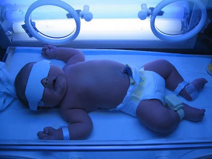 Các bé bị vàng da thường được chiếu đèn