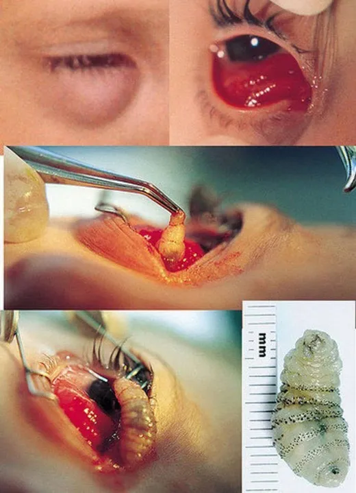 Ký sinh trùng trong mắt