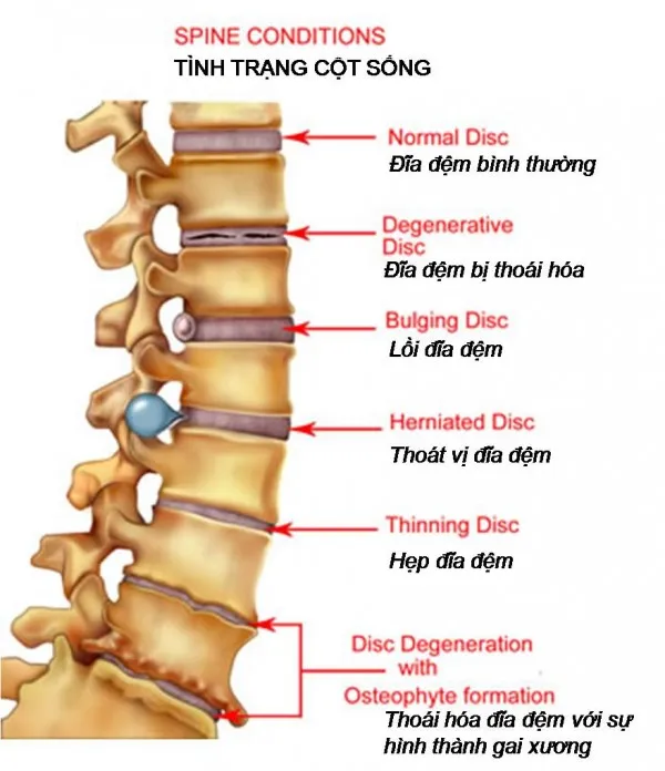 Vị trí và tên gọi các triệu chứng của thoái hóa cột sống
