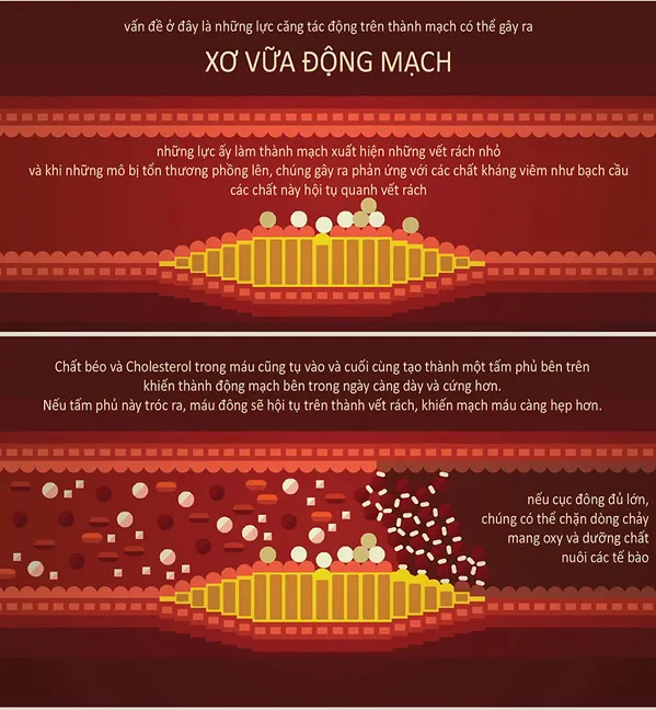 Xơ vữa động mạch