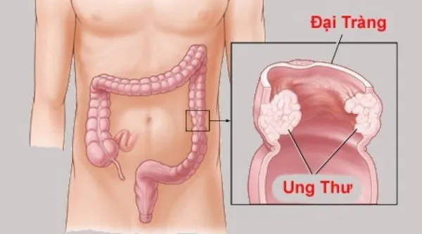 Ung thư đại trực tràng: Triệu chứng, nguyên nhân và cách phòng tránh