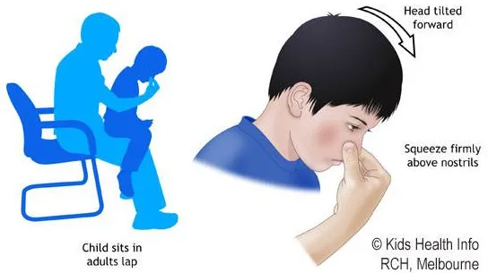 Xử trí khi trẻ chảy máu mũi