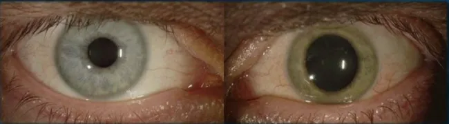 Người bệnh Ebola chưa hề khỏi, virus Ebola đã đánh lừa tất cả chúng ta