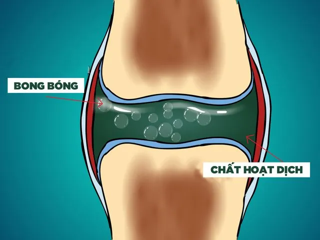 Đến bây giờ, người ta mới biết tiếng "lục cục" khi bẻ khớp đến từ đâu