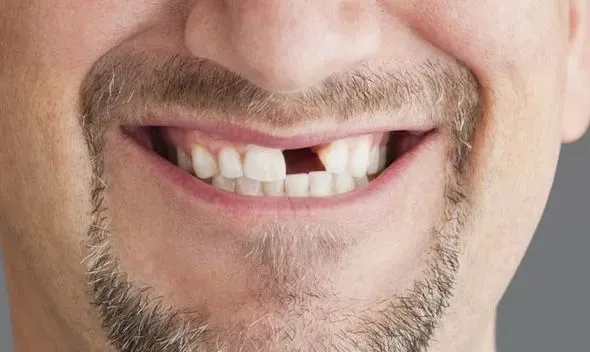 Cứ 10 người thì có 1 người mất răng của họ.
