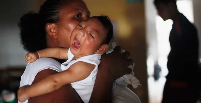 Một em bé bị bệnh đầu nhỏ do virus Zika.
