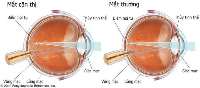 Ở mắt cận thị, hình ảnh sẽ hội tụ ở trước võng mạc thay vì hội tụ ở võng mạc như mắt người thường.