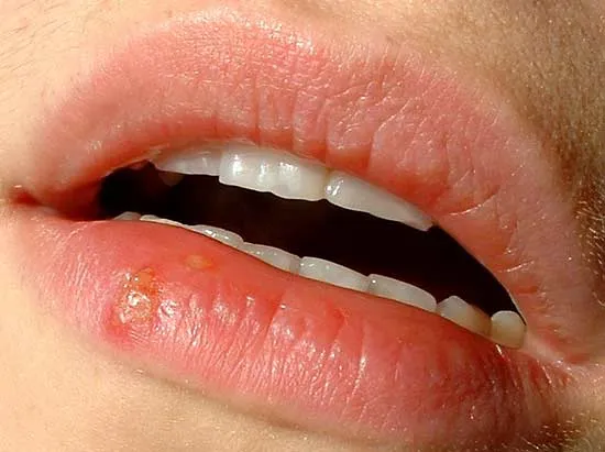 Bệnh mụn rộp