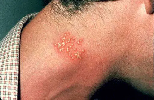 Vết rộp trên cổ do sự phát tán của virus Herpes