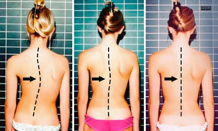 Tập luyện sẽ giúp cột sống thẳng lại và khỏe mạnh.