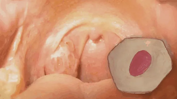 Nhiều người trong chúng ta có sỏi amidan mà không hề hay biết