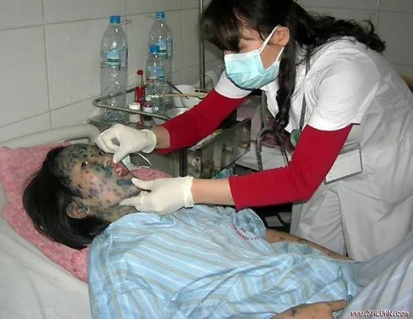 Cả người lớn và trẻ nhỏ đều có thể bị thủy đậu.