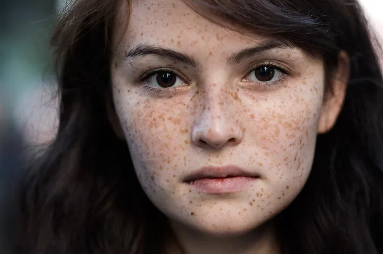 Sắc tố melanin là nguyên nhân gây ra các vết tàn nhang.
