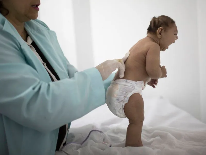 Một em nhỏ mắc chứng teo não.