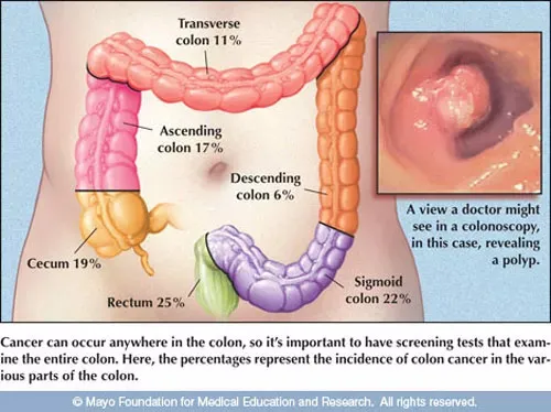 Hình ảnh polyp trong đại tràng, đây là một nguy cơ gây ung thư.