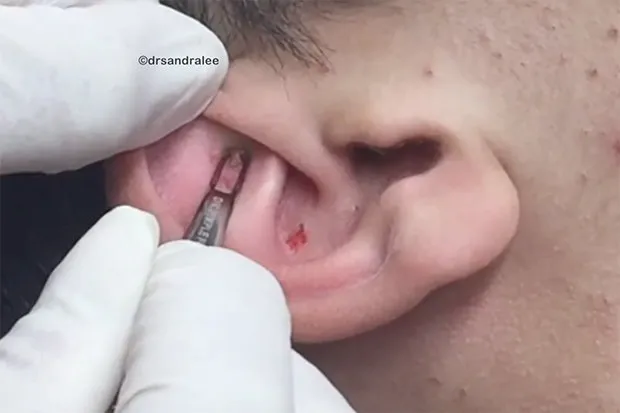 Tai là mô hình thu nhỏ của cơ thể người, nhưng chủ yếu đại diện cho thận