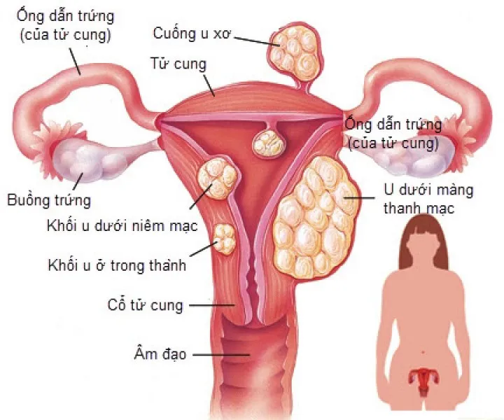 Các vị trí thường xuất hiện u xơ tử cung.