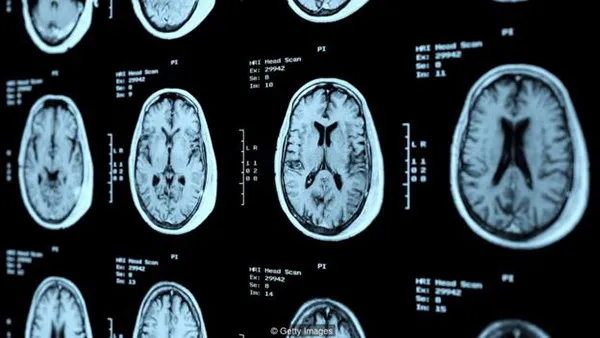 Não của người bị SPD có một số điểm khác so với người thường.