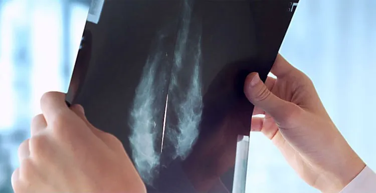 Phụ nữ có gene BRCA1 và BRCA2 bị đột biến sẽ dễ mắc bệnh ung thư vú.