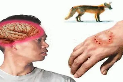 Virus dại chủ yếu lây nhiễm qua vết cắn, hoặc vết thương hở do nước bọt của chó dính vào.
